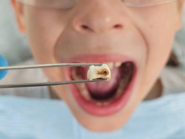 Best Emergency Wisdom Teeth Removal in Taft, FL